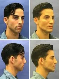 Masculinización facial: definición, técnica y enfoque médico especializado